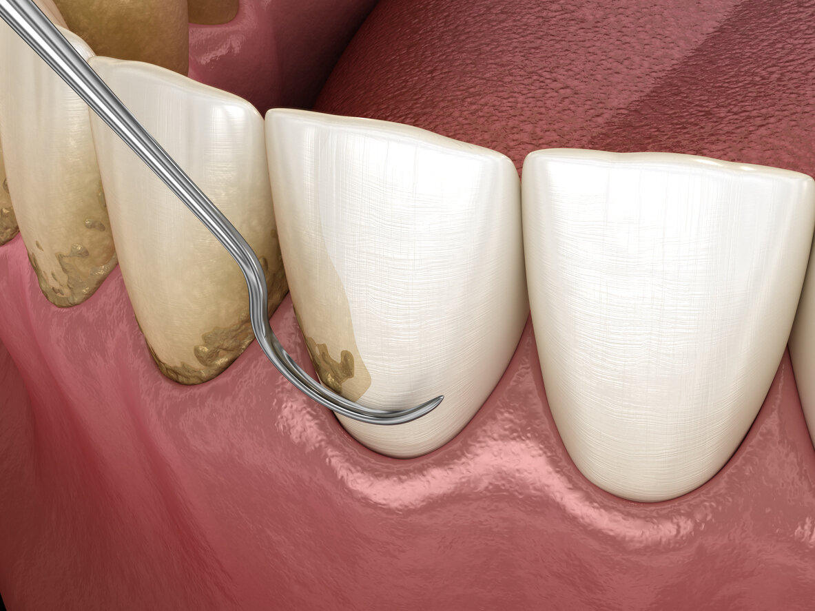 TEETH SCALING TREATMENT